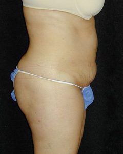 Case--6007 | Before Tummy Tuck 1