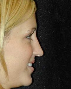 Case--1774 | Before Nose Surgery 1