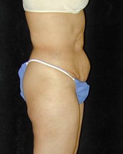 Case--5759 | Before Tummy Tuck 1
