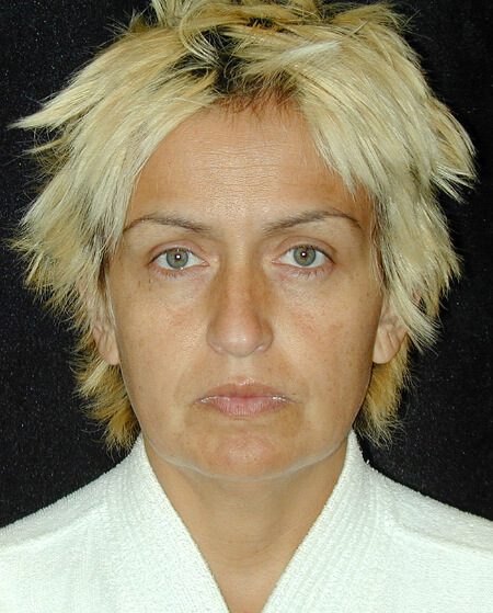 Case--6662 | Before Face Lift and Neck Lift 1