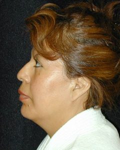 Case--1089 | After Liposuction 1