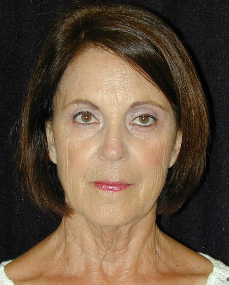 Case--1698 | Before Face Lift and Neck Lift 1