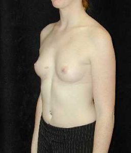 Case--6469 | Before Breast Augmentation 1