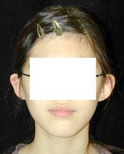 Case--1234 | Before Ear Surgery 1