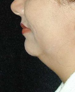 Case--1661 | Before Chin Surgery 1