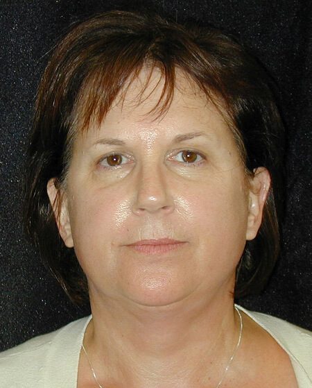 Case--3036 | Before Face Lift and Neck Lift 1