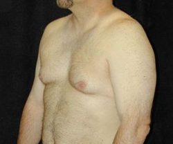 Case--6679 | Before Male Breast Reduction 1