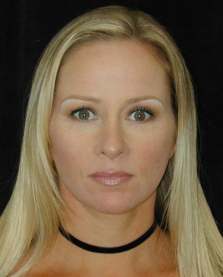 Case--9352 | After Face Lift and Neck Lift 1