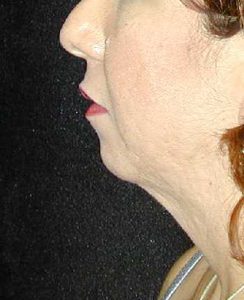 Case--4705 | Before Chin Surgery 1