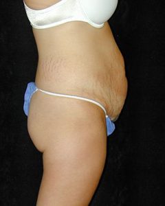 Case--9550 | Before Tummy Tuck 1