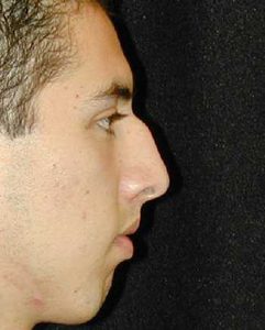 Case--2572 | Before Nose Surgery 1