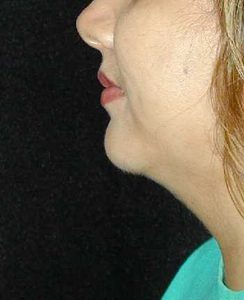 Case--1661 | After Chin Surgery 1