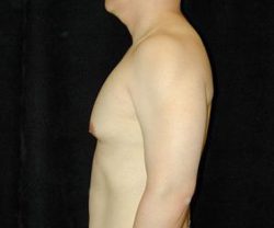 Case--8590 | Before Male Breast Reduction 1