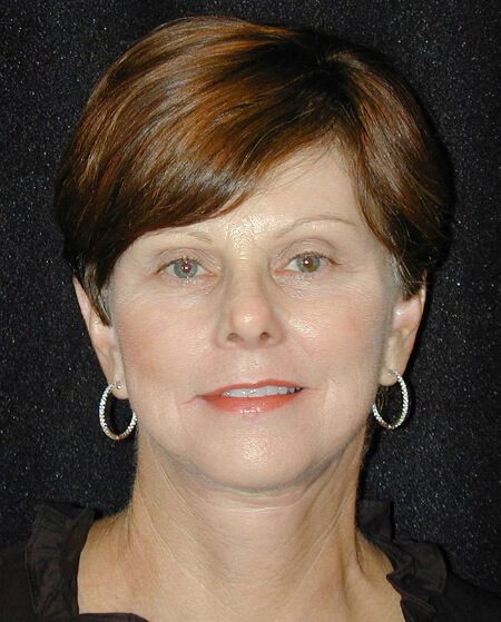 Case--7616 | After Face Lift and Neck Lift 1