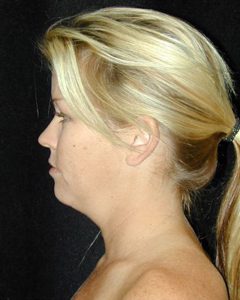 Case--7949 | Before Liposuction 1