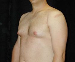 Case--5801 | Before Male Breast Reduction 1