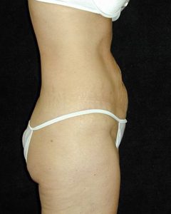Case--8031 | Before Tummy Tuck 1
