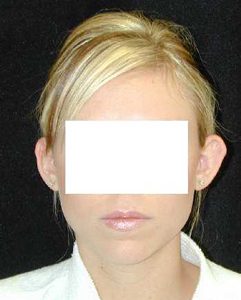 Case--6618 | Before Ear Surgery 1