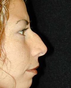 Case--1481 | Before Nose Surgery 1