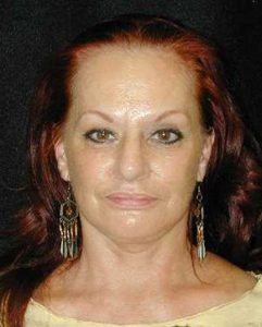 Case--6930 | After Face Lift and Neck Lift 1