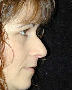 Case--3891 | Before Nose Surgery 1