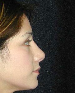 Case--8353 | After Nose Surgery 1