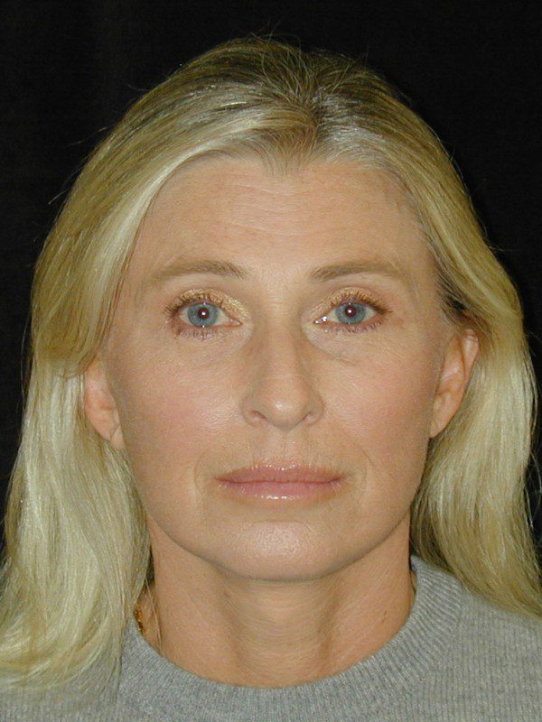 Case--7479 | After Face Lift and Neck Lift 1