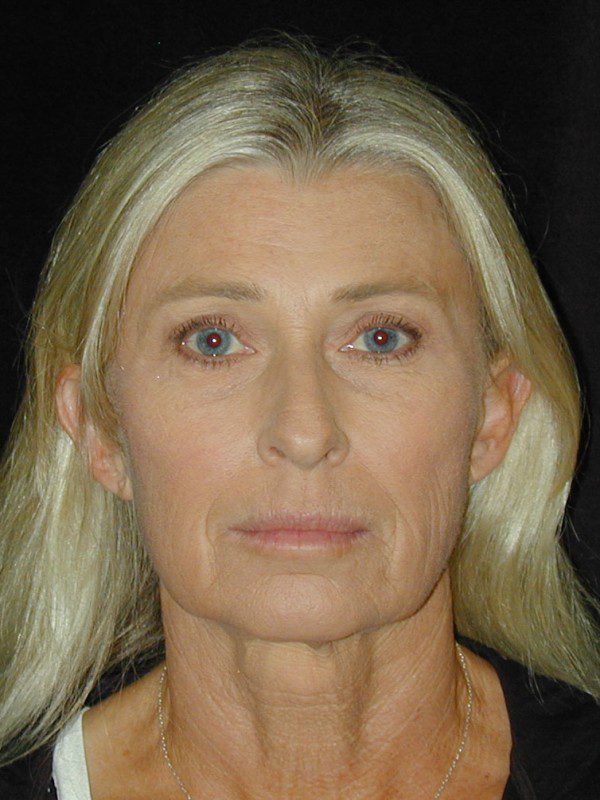 Case--7479 | Before Face Lift and Neck Lift 1