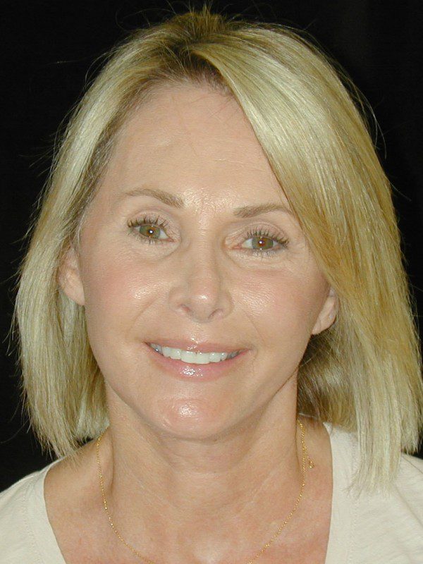 Case--4538 | After Face Lift and Neck Lift 1