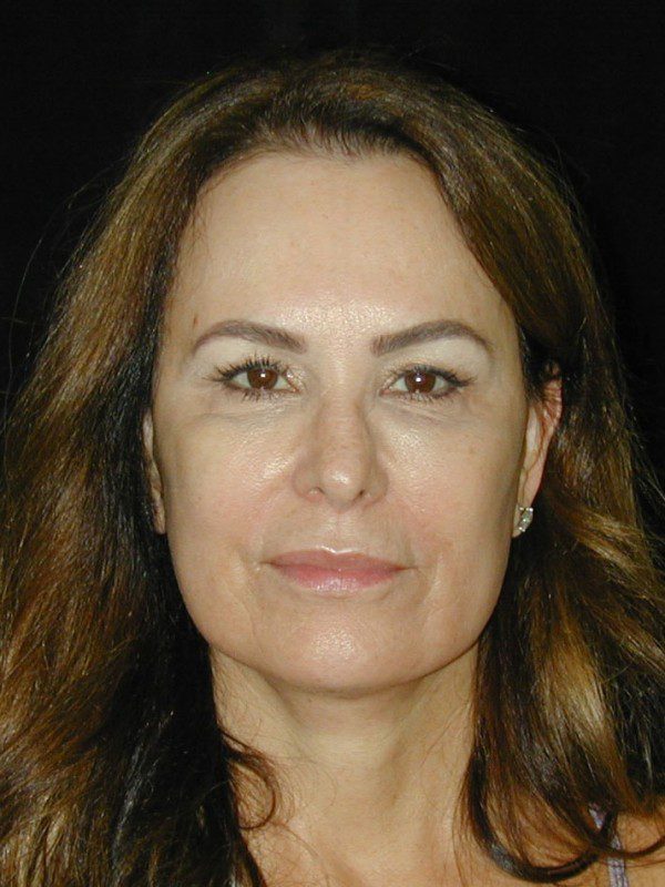 Case--5923 | After Face Lift and Neck Lift 1