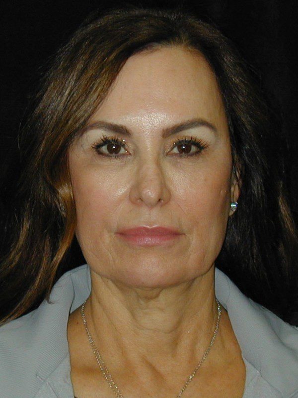 Case--5923 | Before Face Lift and Neck Lift 1