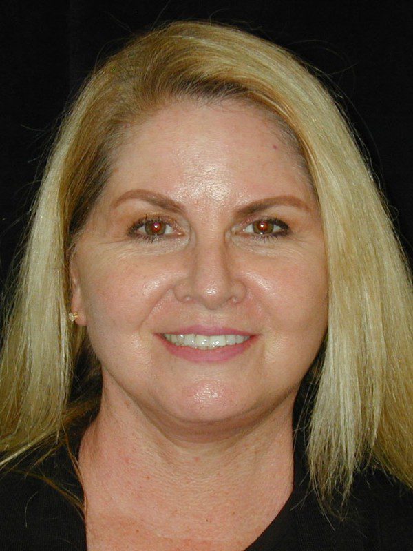 Case--5056 | After Face Lift and Neck Lift 1