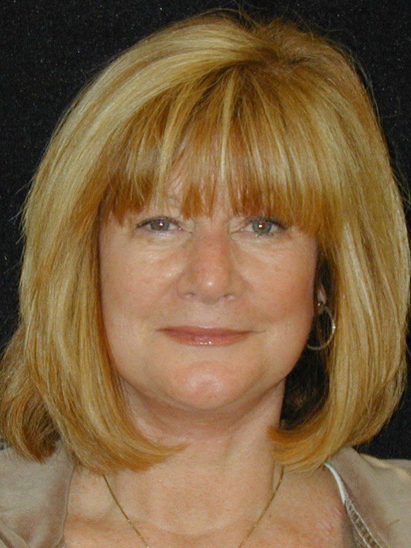 Face-Lift-and-Neck-Lift-Case--7707 | After Face Lift and Neck Lift 1