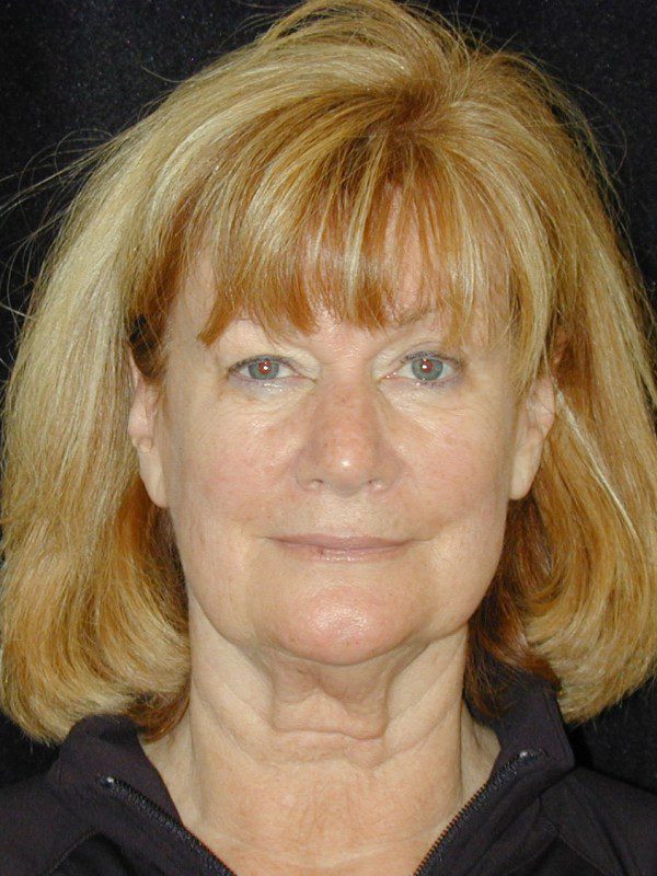 Face-Lift-and-Neck-Lift-Case--7707 | Before Face Lift and Neck Lift 1