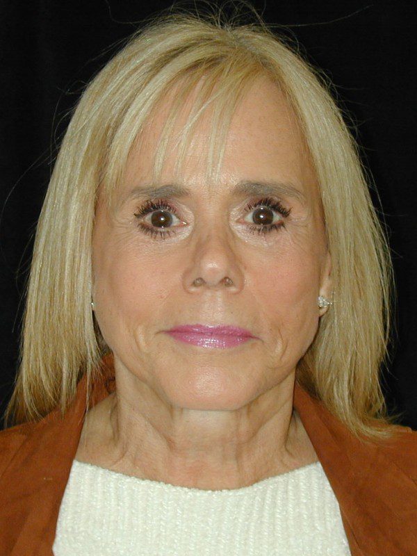 Case--1896 | Before Face Lift and Neck Lift 1