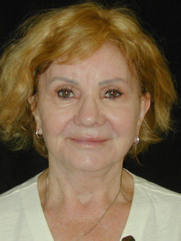 Case--4677 | After Face Lift and Neck Lift 1