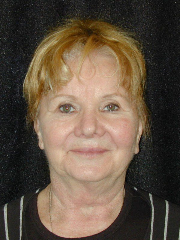 Case--4677 | Before Face Lift and Neck Lift 1