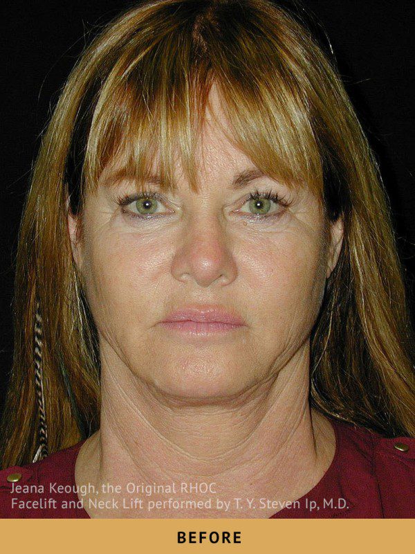 Case--8136 | Before Face Lift and Neck Lift 1