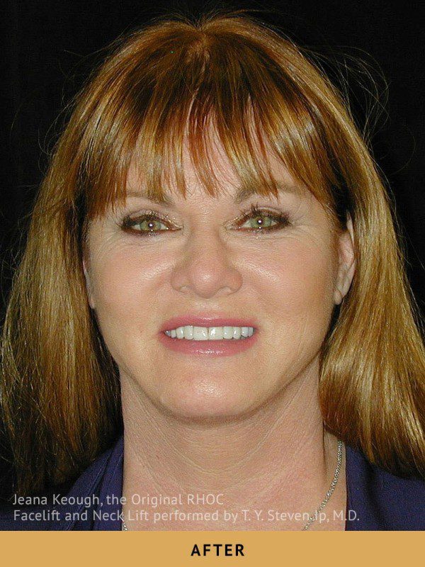 Case--8136 | After Face Lift and Neck Lift 1